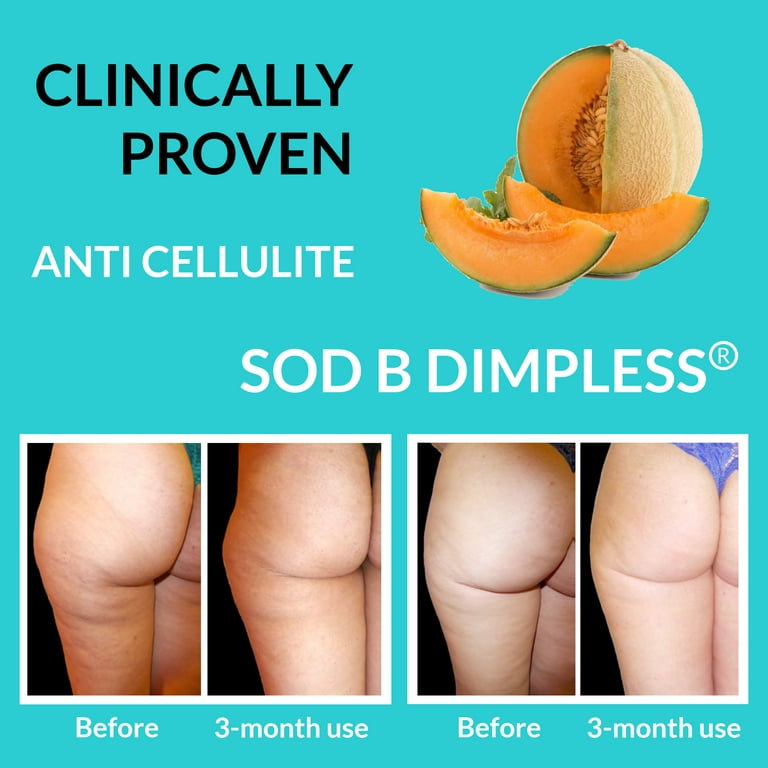 Clinically Proven Cellulite Remover - Varicose Veins Treatment, Restless  Leg Relief, Leg Circulation, Anti Cellulite Supplements - Caviar Collagen,  SOD, Butchers Broom & Horse Chestnut Capsules, 90 ct 