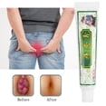 thumbnail image 3 of Ungüento Para Hemorroides, Ungüento Para Aliviar El Dolor, Tratamiento De Desinfección, Crema Para El Cuidado De La Salud, 3 of 7