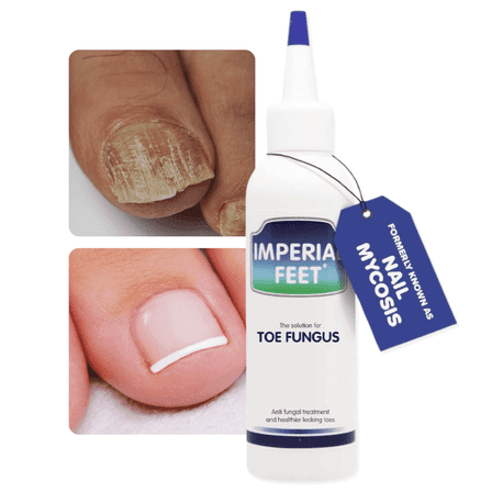 Toenail Fungus - Severe  Fungal Nail Treatment   -  Damaged Yellow Nail Care - Nail Care for Discolored & Brittle Toenails - XL - Nail Mysocis Improved Formula