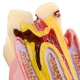 thumbnail image 5 of Dental Tooth Decay Model 6 Times Dental Caries Teeth Model, 5 of 7
