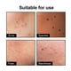 thumbnail image 5 of Limited time offer!Acne Removal Patch For Facial Acne, Lightening And Repairing Acne, Closed Mouth Acne Marks, And Blackhead Removal, 5 of 9