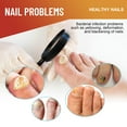 thumbnail image 4 of BKER Ongle de Pied Extra Fort pour Ongle de Pied 8 Heures de Nuit, 4 of 7