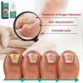 thumbnail image 4 of Anti Nail-Fungus Liquid for Grey Nails Uneven Colors Nail, Quick Absorption Nail Strengthening Cream, Nails Care Supplies, 4 of 5