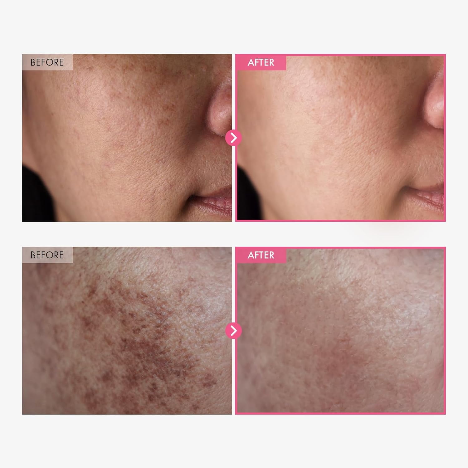 Arbutin + Tranexamic Acid Cream, 70,000ppm Arbutin, 40,000