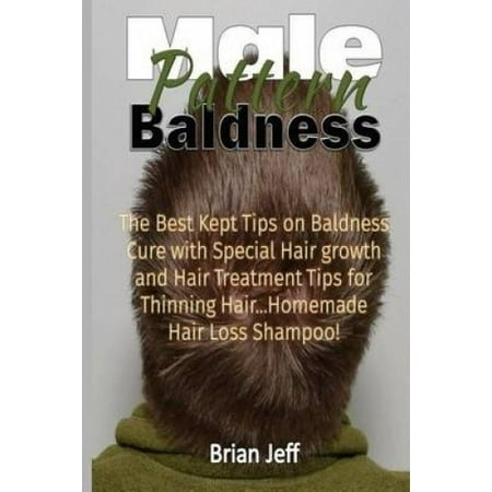 Male Pattern Baldness: The Best Kept Tips on Baldness Cure with Special ...