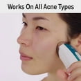 thumbnail image 4 of Silk’n Blue - Acne Treatment Device with Blue Light Therapy - Clinically Proven, Chemical Free Treatment, 4 of 5