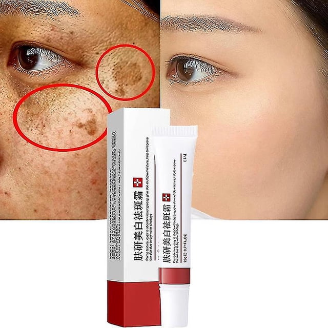 Crema blanqueadora eficaz para pecas, elimina el Melasma, pigmento para manchas de acné, pigmentación de manchas oscuras, Gel hidratante para el cuidado de la piel
