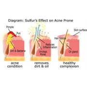 Sulfur Soap for Acne 3-Pack Shipping Included | Joesoef Skin Care Anti Acne Sulfur Soap 100G each 3 pack