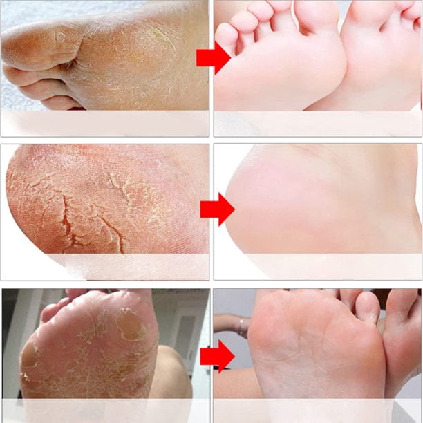 Foot Peel - (5 Peeling Away Calluses and Dead Skin Cells - Exfoliating Foot Mask, Baby Soft Smooth Touch Feet-Men Women - Walmart.com