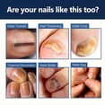 thumbnail image 5 of Fungal Nail Treatment Cream, Strong Anti-Fungal Toenail Cream, Fungal Nail Treatment For Toenail Fungus & Nail Repair, 5 of 5