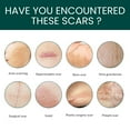 thumbnail image 4 of Silicone Scar Tape(1.6"x 60" Roll-1.5M),Silicone Scar Tape for Scar Removal Treatment,Reusable Silicone Scar Strips for C-Section,Keloid,Burn,Acne,Surgical Scars, 4 of 7