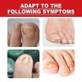 thumbnail image 3 of Barsinfi 30ML Ingrown Toenail Treatment,nail Growth Treatment,ingrown Toenail Drops Cuticle Nail Oil Ingrown Toenail Correction, 3 of 5
