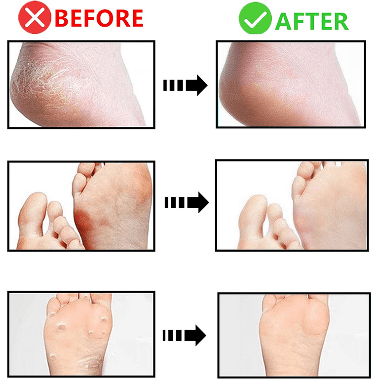 Zlongron Double-Sided Foot File, Callus Remover for feet Suitable for feet  Dry Cracked, Dead Skin, calluses, etc., Heel Scraper for Cracked Heels