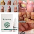 thumbnail image 2 of Cuidado De Los Pies Antihongos 10ml Cuidado De Los Pies Antihongos Eliminación De Hongos Infección Máxima Fuerza Herbal Pie Hongos Reparación Tratamiento De Uñas ANGGREK No, 2 of 5