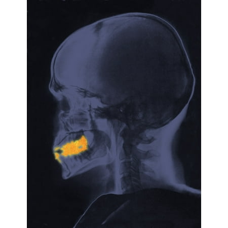 - Skull x-ray with dental fillings Stretched Canvas - Science Source (24 x 36)