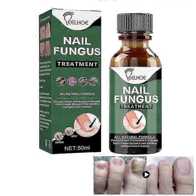 EELHOE Nail Repair Liquid Gray Nail Liquid Uneven Thick Nail Thickening Gray Nail Soft Nail Hand and Foot R