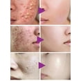 thumbnail image 5 of Crema de tratamiento para el acné, árbol de té, Control de aceite retráctil de poros, blanqueamiento, reparación de granos, Limpieza Profunda, hidratante antiacné, cuidado de la piel facial, 5 of 5