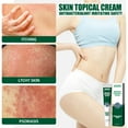 Ringworm Treatment Ringworm Cream Relieves Itching Cream