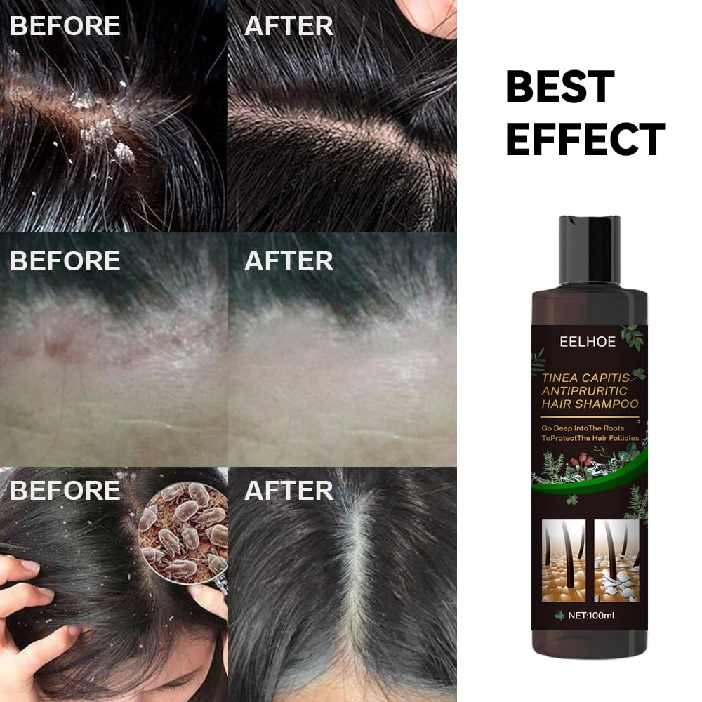 Ringshlar Hair Shampoo for Tinea Capitis Antipuritic Professional Antidandruff Remove Mites and Relieve Itching Shampoo 10.14 Oz