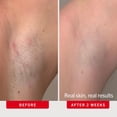 thumbnail image 4 of Discos para vellos encarnados First Aid Beauty con BHA y AHA, 60 unidades, 4 of 9