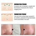 thumbnail image 3 of Blackhead Removal Nasal Mask Gently And Deeply Cleans Pores To Suck Blackheads And Acne Comes With 60 Sheets Of Tear-off Nose M, 3 of 5