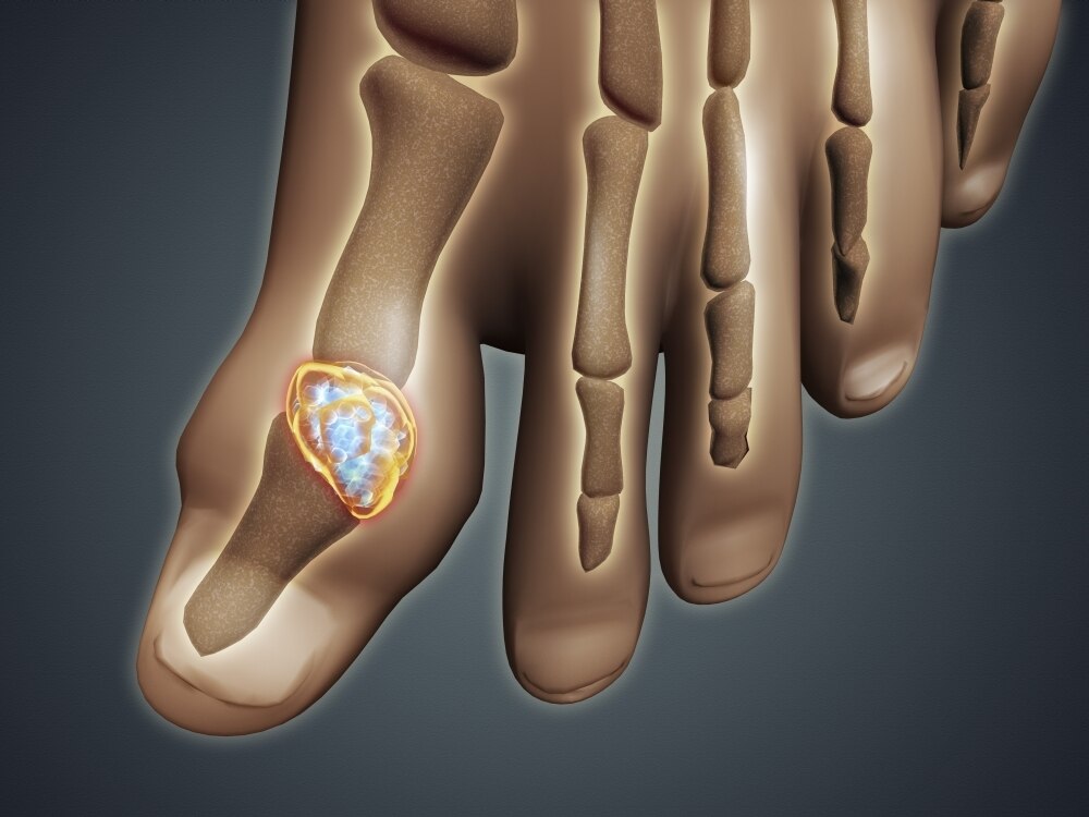 conceptual-image-of-gout-in-the-big-toe-gout-is-a-form-of-inflammatory
