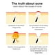 thumbnail image 3 of Clearance, Salicylic Acne Removing Gel - Facial Oil Control And - Lightens Acne - Promotes Skin Metabolism, 3 of 4