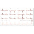 thumbnail image 3 of CafePress - Ecgs Of A Normal Heart Rate, Artwork Large Mug - 15 oz Ceramic Large White Novelty Mug, 3 of 6