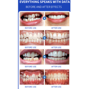 XIRQI Tooth Repair Kit,Improve the Condition of the Front Teeth Mouth Guard,Slows Cheek Muscle Contraction Teeth Whitening,Phase One