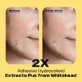 thumbnail image 3 of Avarelle Cosmetics ZITOUT Invisible Hydrocolloid Pimple Patch, 24 ct, 3 of 8