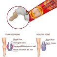 thumbnail image 3 of Sumifun, 10 Uds., ungüento para venas varicosas, yeso médico, tratamiento para el cuidado de la piel, vasculitis, flebitis, araña, varicosidad, angiitis, cremas kaili Sencillez, 3 of 4