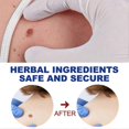 thumbnail image 4 of CHAO Ungüentos limpiadores de verrugas de 20 g Crema antimanchas para atenuar los nevos de la piel para uso externo Caja de 3 unidades de 20 g, 4 of 5