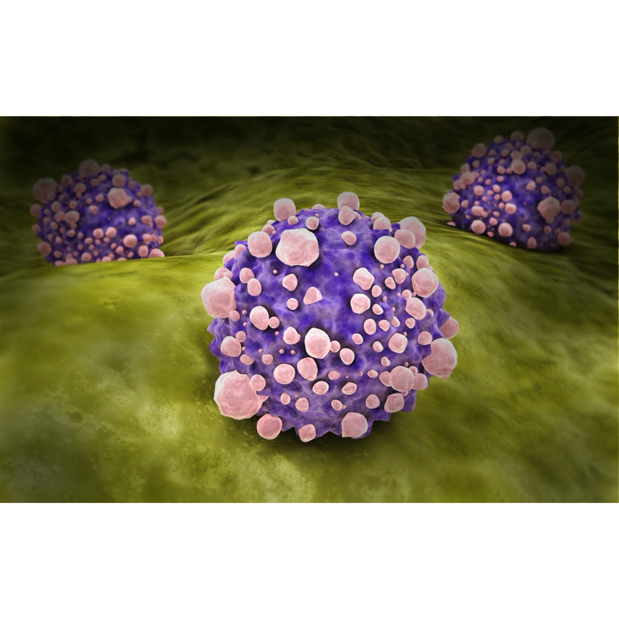 Microscipic view of pancreatic cancer cells Canvas Art - Stocktrek Images (18 x 12)