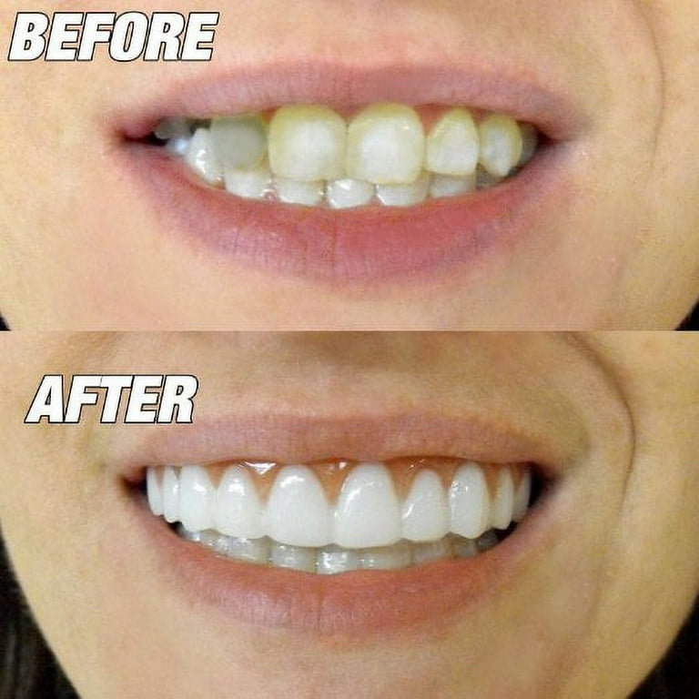 Instant Smile, Comfort Fit Snap On Veneers, Ultra Thin Cosmetic
