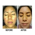 thumbnail image 4 of SkinSanity Clear Skin Results Regimen - All Natural Acne Treatment, 4 of 12