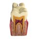 thumbnail image 1 of Modelo De Herramienta De Enseñanza Cariados Dispensión Gingival Modelo 2 DYNWAVEMX Molde de estudio de compactación de caries, 1 of 5