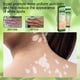 thumbnail image 4 of Crema para manchas dulces de 20g para hombres y mujeres crema para el tratamiento de manchas blancas suministros para el cuidado de la piel, 4 of 6