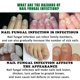 thumbnail image 5 of JAYSUING 30ml Ginger Extract Nail Fungus Treatment Nourishing Liquid for Hand Foot Nails, zjxhy809cy, 5 of 5