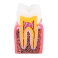 thumbnail image 4 of Modelo de dientes Octpeak Estudio de comparación de caries Saludable, 4 of 7