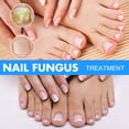 thumbnail image 4 of Nail fungo treatment - soluciones antifúngicas y tratamientos de hongos de uñas bajo las uñas - reparación de dedos y uñas CAIXIN Solución reparadora para uñas, 4 of 6