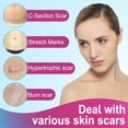 thumbnail image 3 of Silicone Scar Sheets Roll - Helps Support Scar Appearance for Old & New Scars, Cut-to-Size (1.6" x 75"), 3 of 10