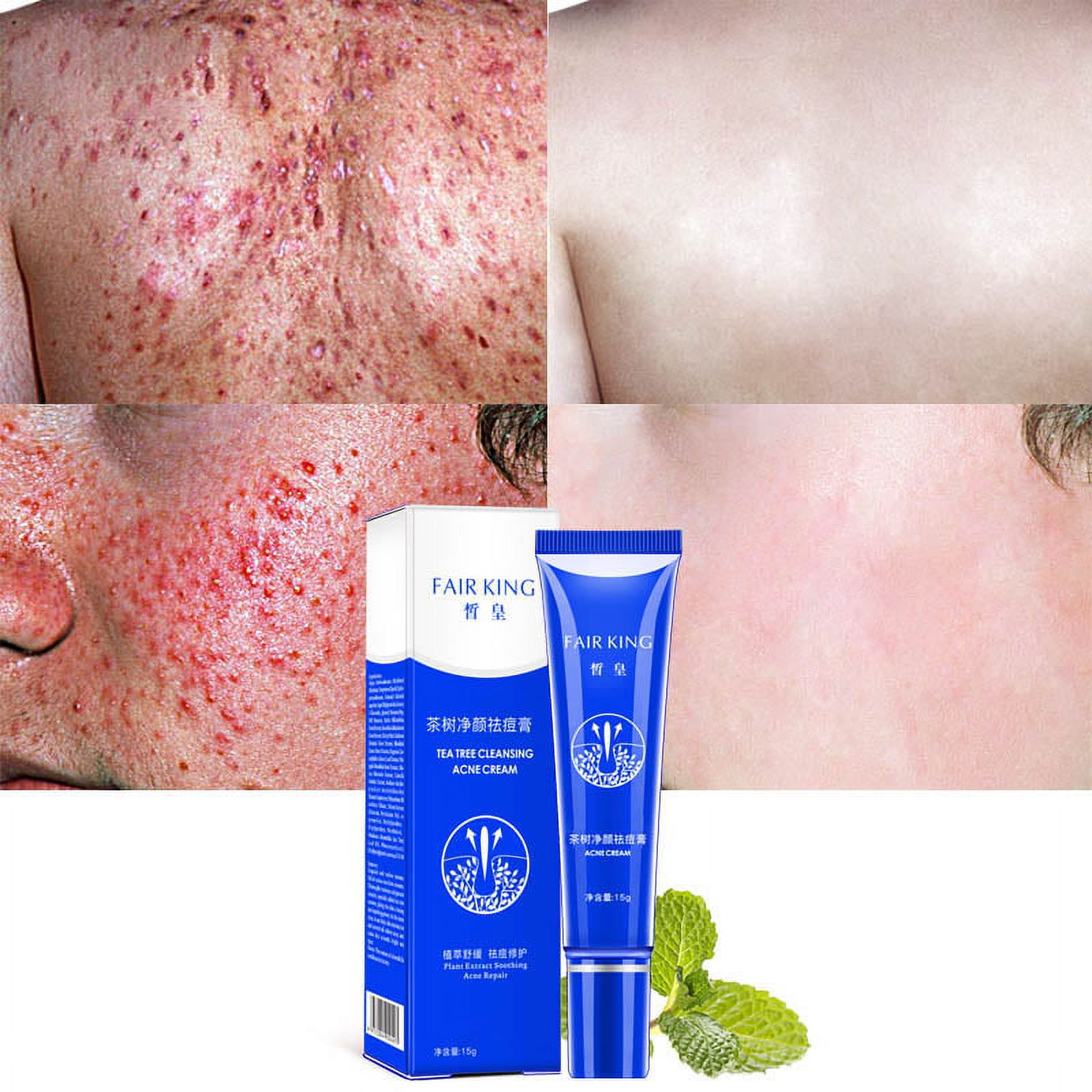 cystic-acne-spot-cream-fast-acting-formula-cream-for-clearing-severe