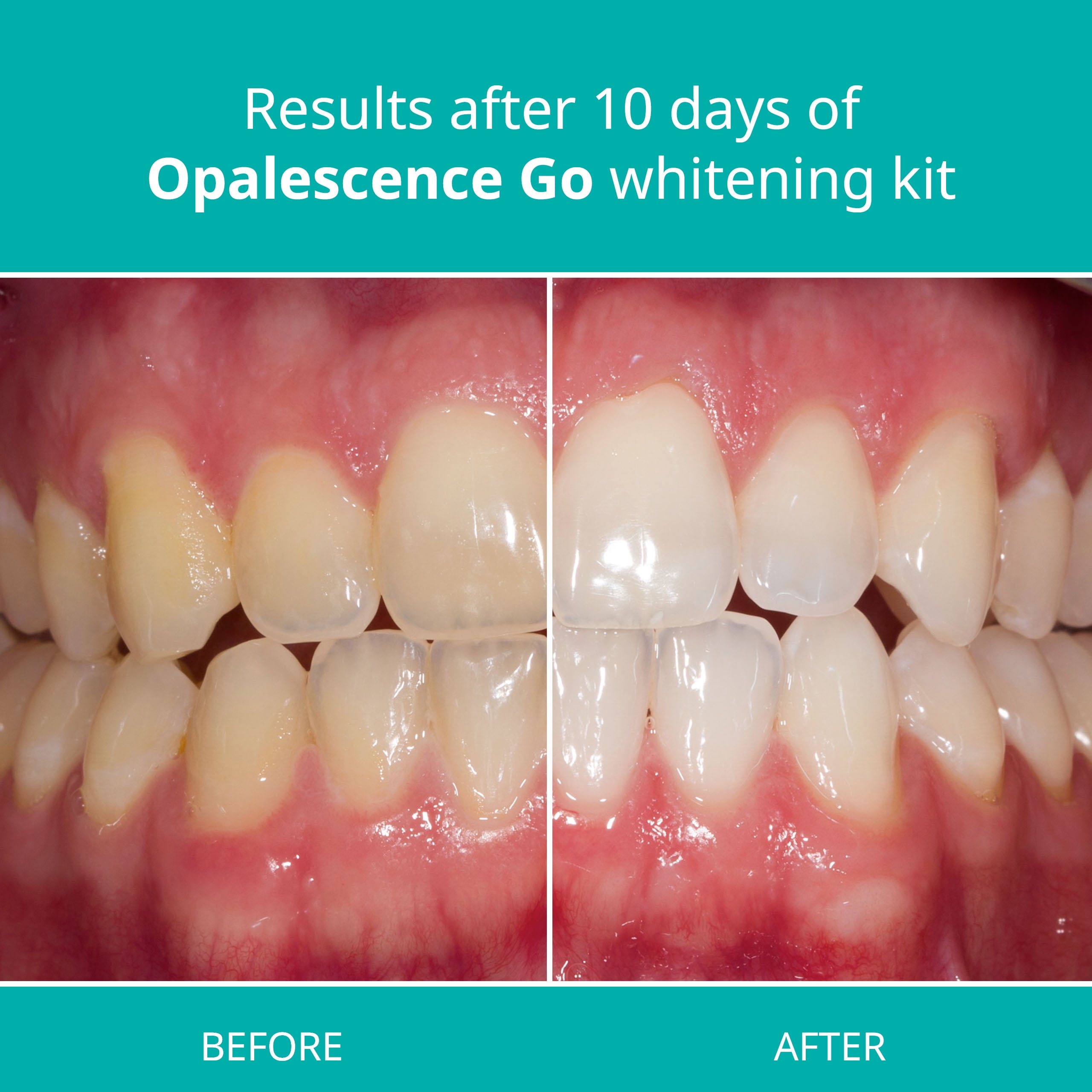 Opalescence Go™ - Prefilled Teeth Whitening Trays - 15% Hydrogen Peroxide -  Mint