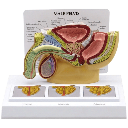 GPI Anatomical Male Pelvis with 3D Enlarged Prostate Model