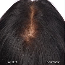 Hairmax FDA Cleared Laser Hair Growth Cap, Hair Loss & Regrowth Treatment, Unisex, One Size, 1 Piece