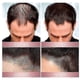 thumbnail image 5 of 3Pcs Zephta H-Regrow 2.0, Zephta Hair Regrowth, Prorevita Rice Nutri Spray, for Hair, 5 of 5