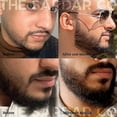 thumbnail image 3 of Derma Roller for Hair & Beard Growth - Microneedling 0.3mm, 3 of 5