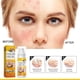 thumbnail image 4 of Crema para tratar el acné Crema para tratar el acné quístico, hormonal y severo Crema para tratar el acné en adolescentes y adultos, 4 of 5
