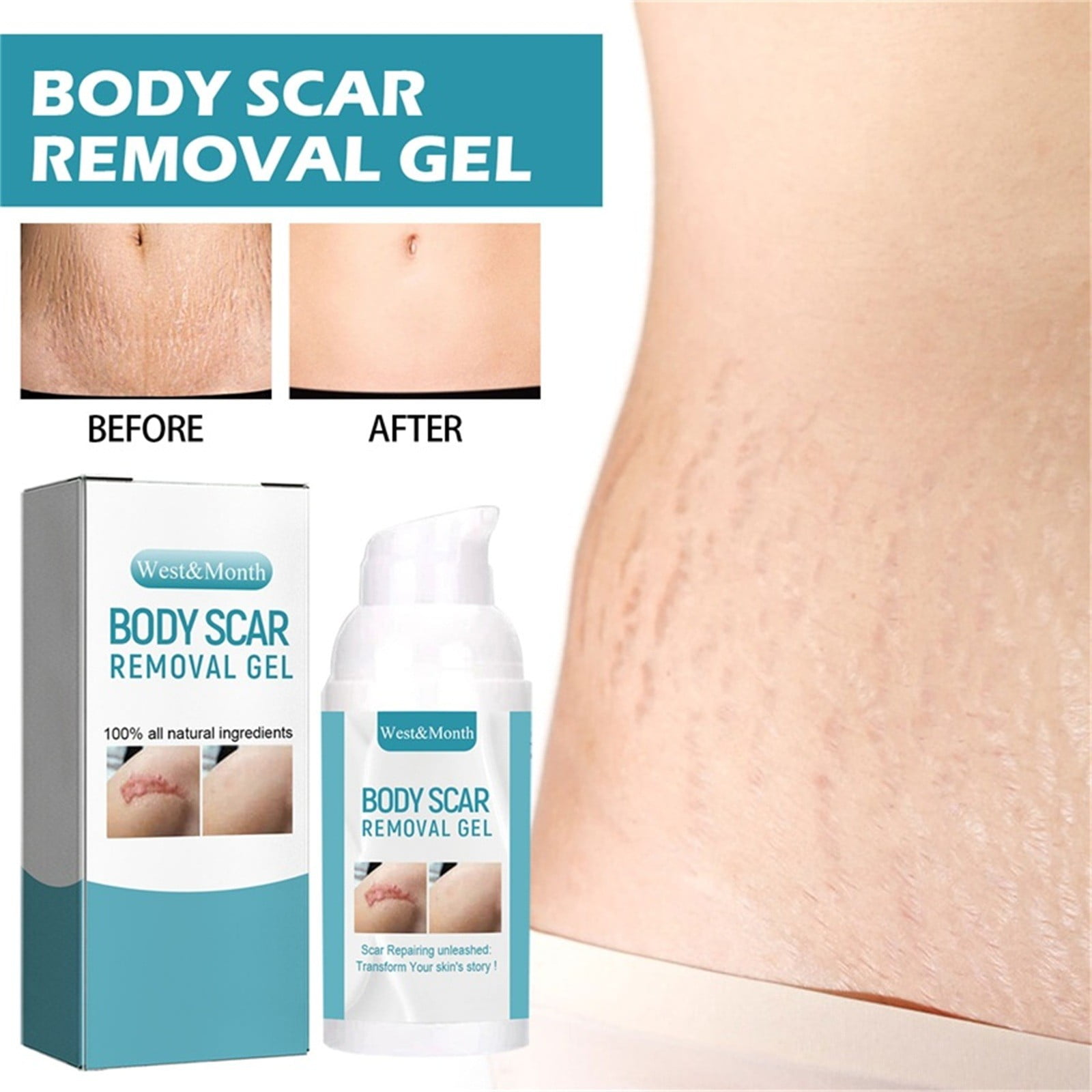 Komiseup Scar Cream, for C-Section, Tummy Tuck, Keloid, and Surgical Scars, Stretch Marks, Keloids,Scar Treatments for Old & New Scars,Scar Removal for Women Men