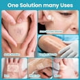 thumbnail image 5 of Hydrocolloid Roll for Wound Care: 2IN*6.5FT - Waterproof Ultra Thin Self Adhesive Patch for Blisters Acne Bedsores Pressure Diabetic Ulcers - DIY Size - Home First Aid Kit Essential, 5 of 5